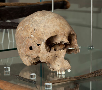 Kranium med fyrkantigt hål i tinningen i en museumsmonter. 